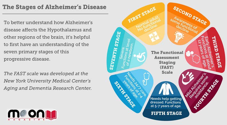 مراحل پیشرفت بیماری آلزایمر